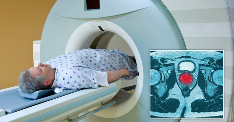 Prostate cancer deaths could be 'significantly' reduced with simple MRI scan