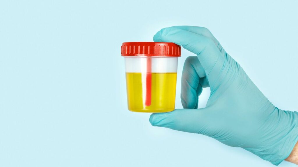 New Urine Test for Prostate Cancer May Help Reduce Unnecessary Biopsies